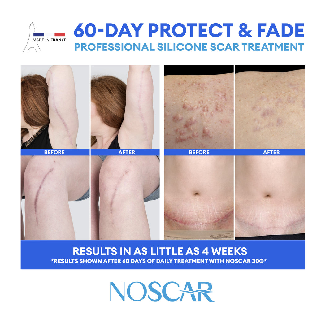 NoScar
